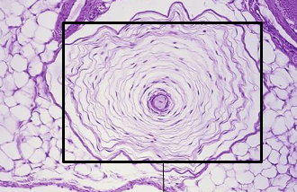 <p>A type of encapsulated nerve ending located deeper in the dermis and subcutaneous tissue, responsible for detecting deep pressure and vibration. They are large, onion-like structures that respond to rapid changes in pressure. </p>