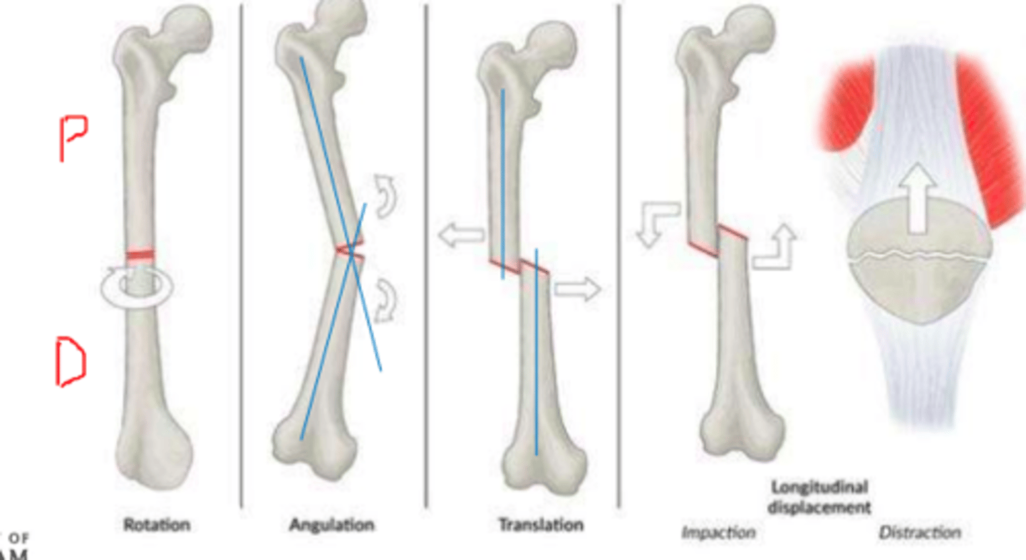 <p>Movement of distal fragment in relation to the proximal component </p><p>Rotation</p><p>Angulation</p><p>Translation</p><p>Longitudinal </p>