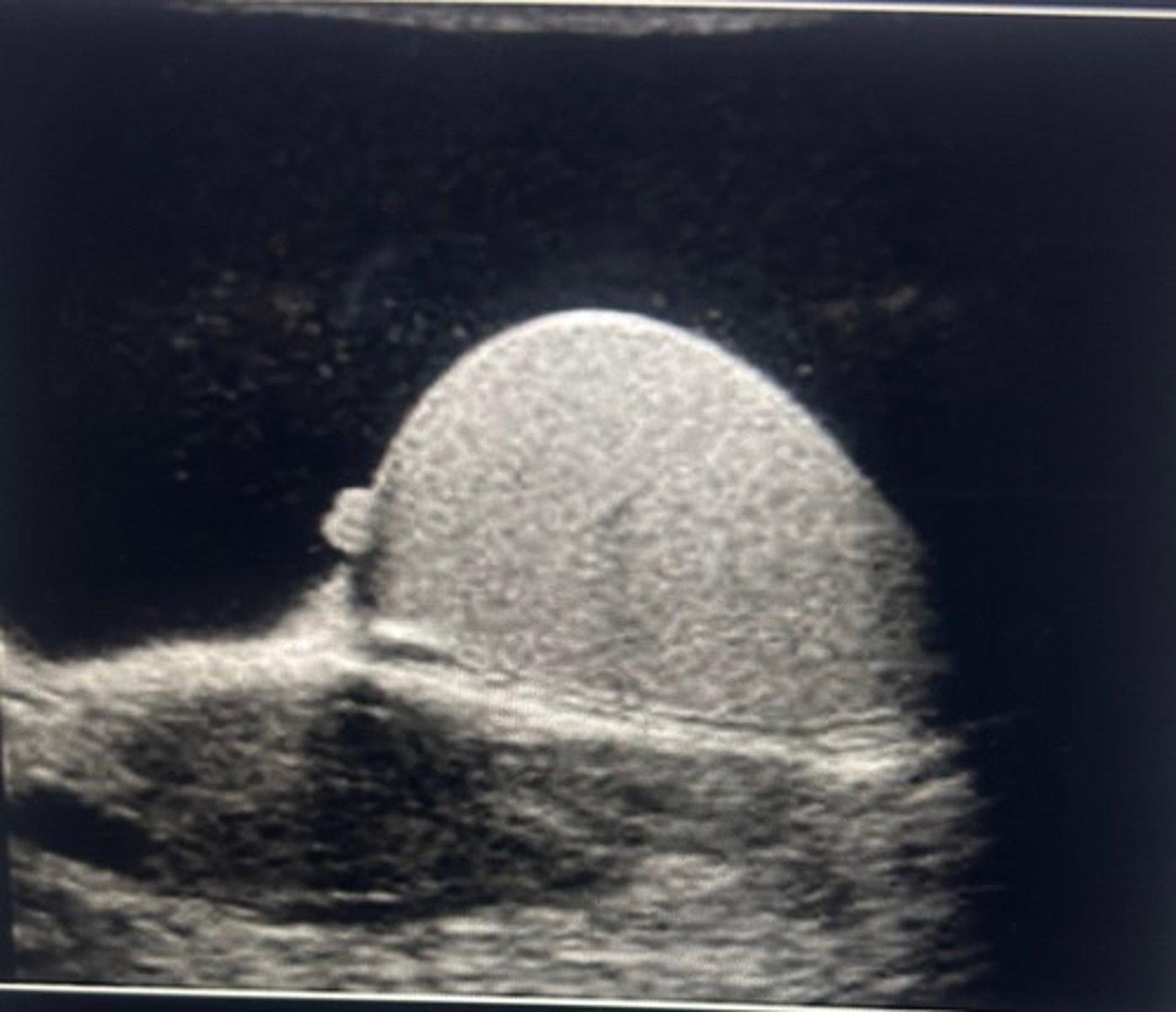 <p>there is a hydrocele and appendix testis visible on the image</p>