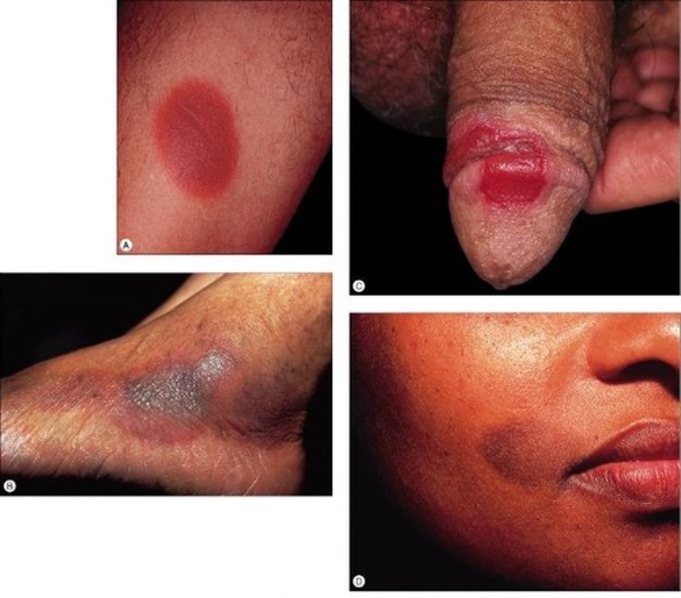 <p>This type of drug reaction will have early lesions that are sharply demarcated erythematous macules, they can then form a plaque which may turn into a bulla , then an erosion. Once healed it will be dark brown to violet colored.</p>