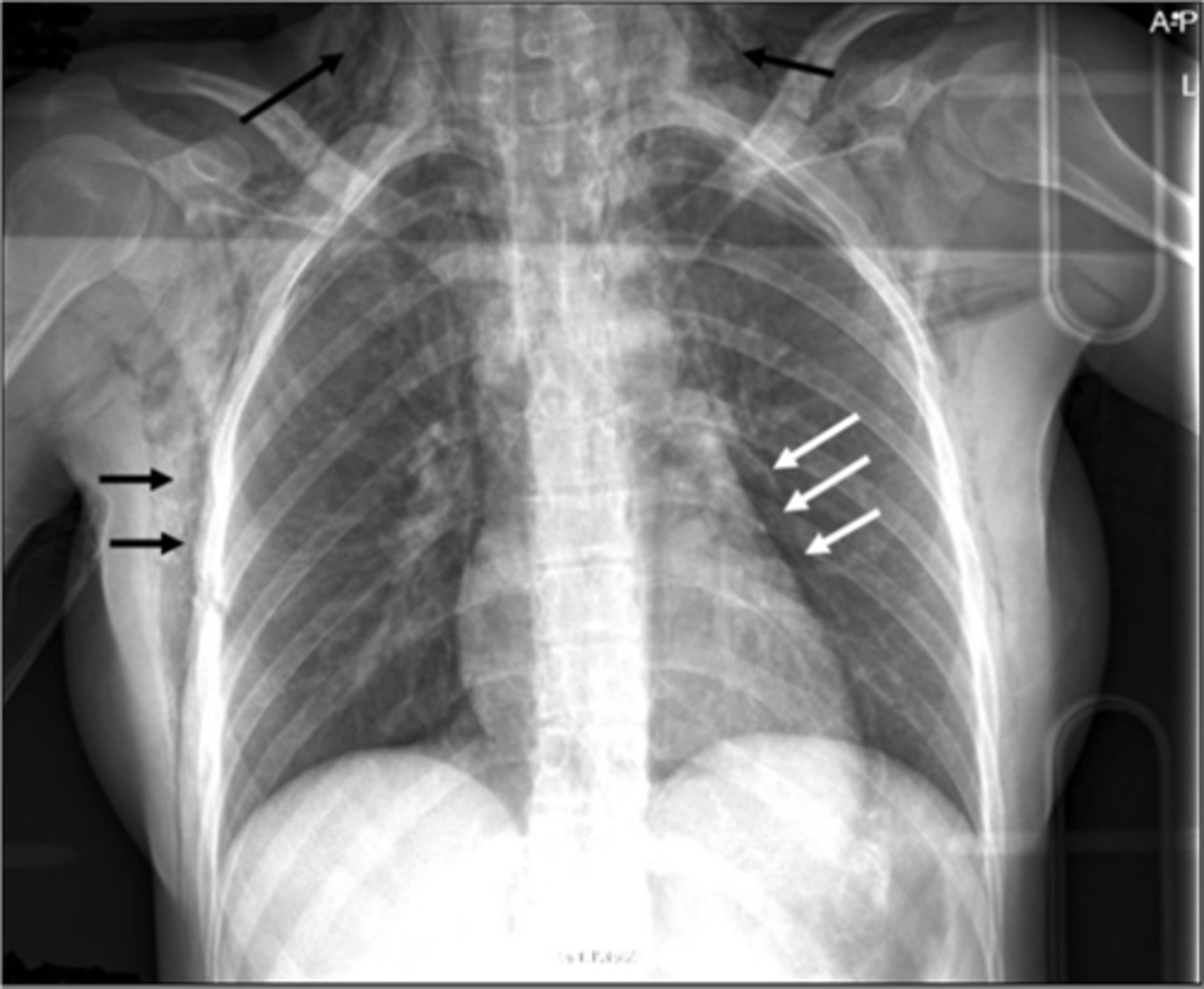 <p>very thick white line on the subcutaneous area</p>