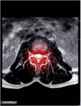<p><span>The image below depicts an MRI of the spine (shown in red). On what plane was the image taken?</span></p><p></p>