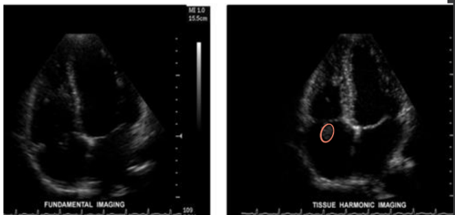 <p>(1) cardiac scanning</p><p>(2) difficult patient habitus</p><p>(3) further delineating or defining masses with an organ</p>