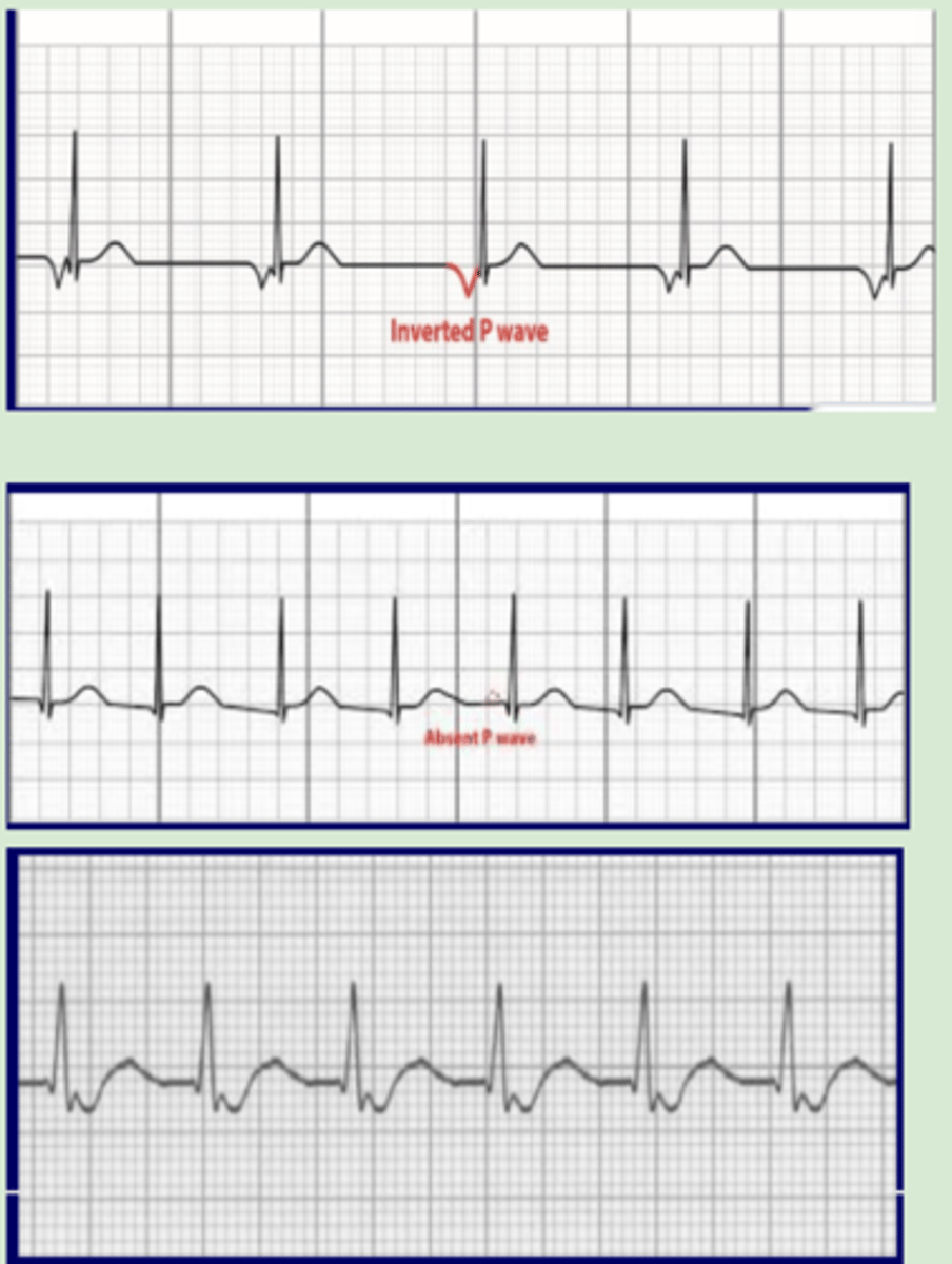 <p>Originate: AV node</p><p>QRS complex: narrow</p><p>P wave:</p><p>-Top of AV node = inverted, prior to QRS</p><p>-Middle of AV node = hidden in QRS</p><p>-Bottom of AV node = inverted, after QRS</p><p>Heart rate: 40-60 bpm</p><p>R-R intervals: regular</p><p>-Accelerated junctional rhythm: &gt;60-100 bpm</p><p>-Junctional tachycardia: &gt;100 bpm</p>