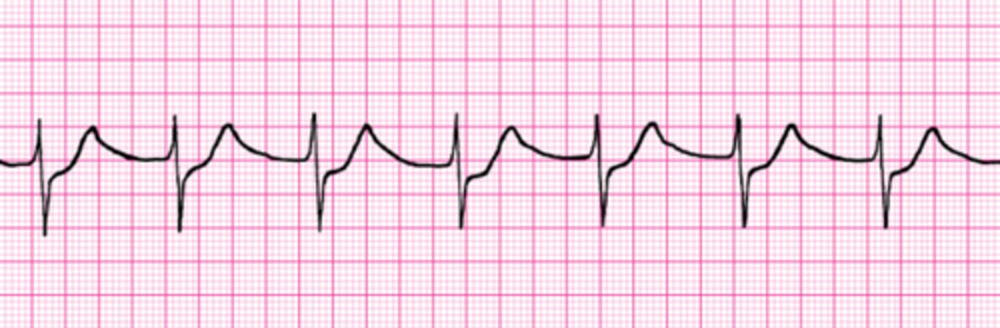 <p>HR = 71</p><p>No apparent P-waves</p>