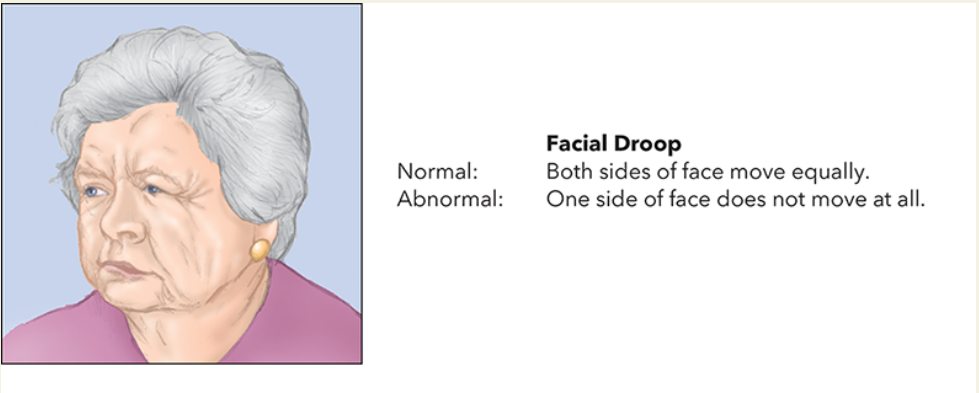 <ul><li><p>Ask the patient to grimace or smile. (Demonstrate what you want the patient to do, making sure that you show your teeth. This allows you to test the control of the facial muscles.)</p><ul><li><p>A normal response is for the patients to move both sides of their face equally and to show you their teeth.</p></li><li><p>An abnormal response is unequal movement or no movement at all.</p></li></ul></li></ul><p></p>