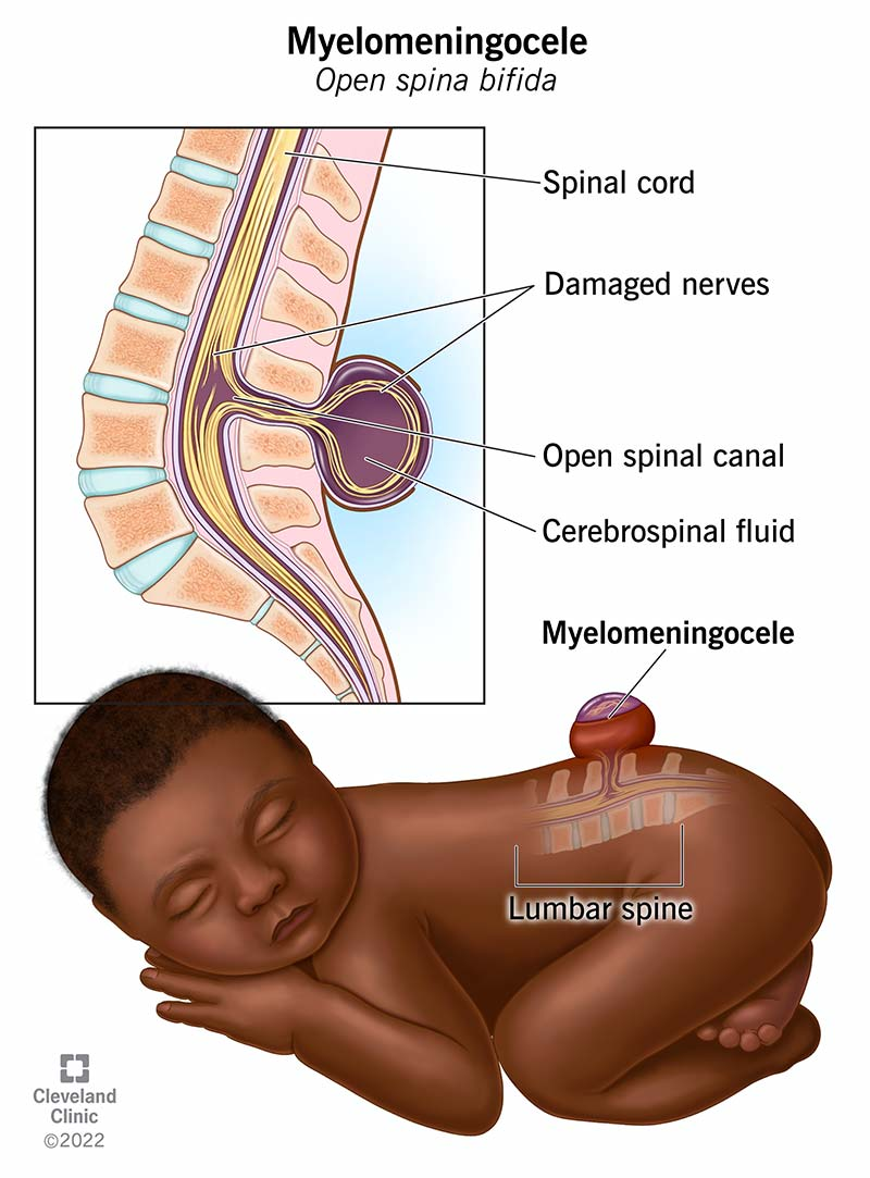 <p>Myelomeningocele</p>