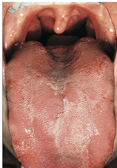 <ul><li><p>appears as red and then paler pink to white patches on body of tongue</p></li><li><p>change shape with time resembling geographic map</p></li></ul><p></p>