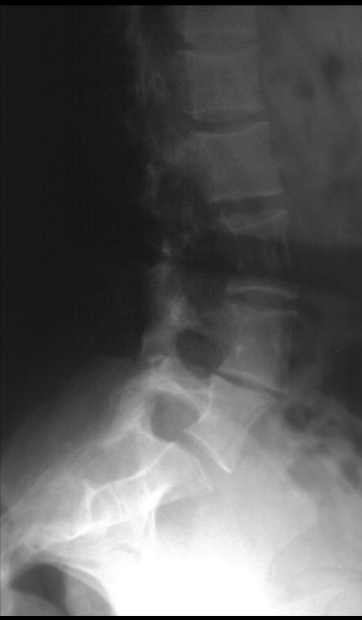 <p>what is seen here for this case of neurofibromatosis type 1?</p>