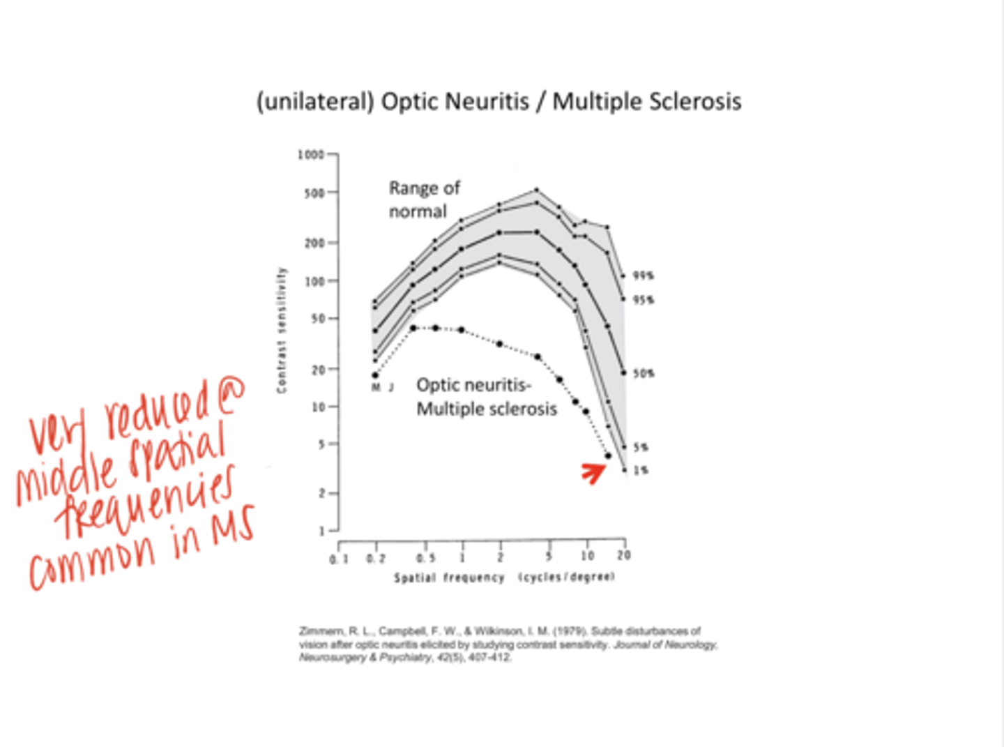 <p>With MS, there will be very reduced ____ spatial frequencies</p>