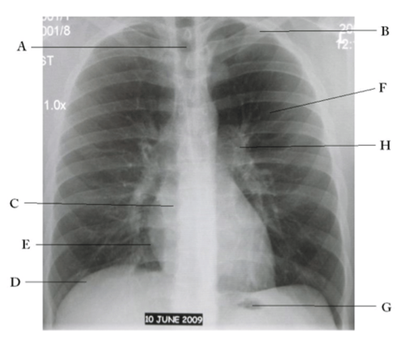 <p>oA - Trachea</p><p>oB - Clavicle</p><p>oC - Right Atrium</p><p>oD - Diaphragm</p><p>oE - Cardiophrenic angle (Costocardio)</p><p>oF - Left upper lobe</p><p>oG - Gastric Bubble</p><p>oH - Left Hilum</p>