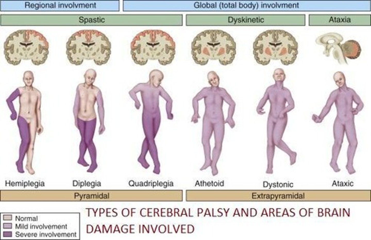 <p>Spastic paralysis caused by loss of function of descending motor pathways.</p>