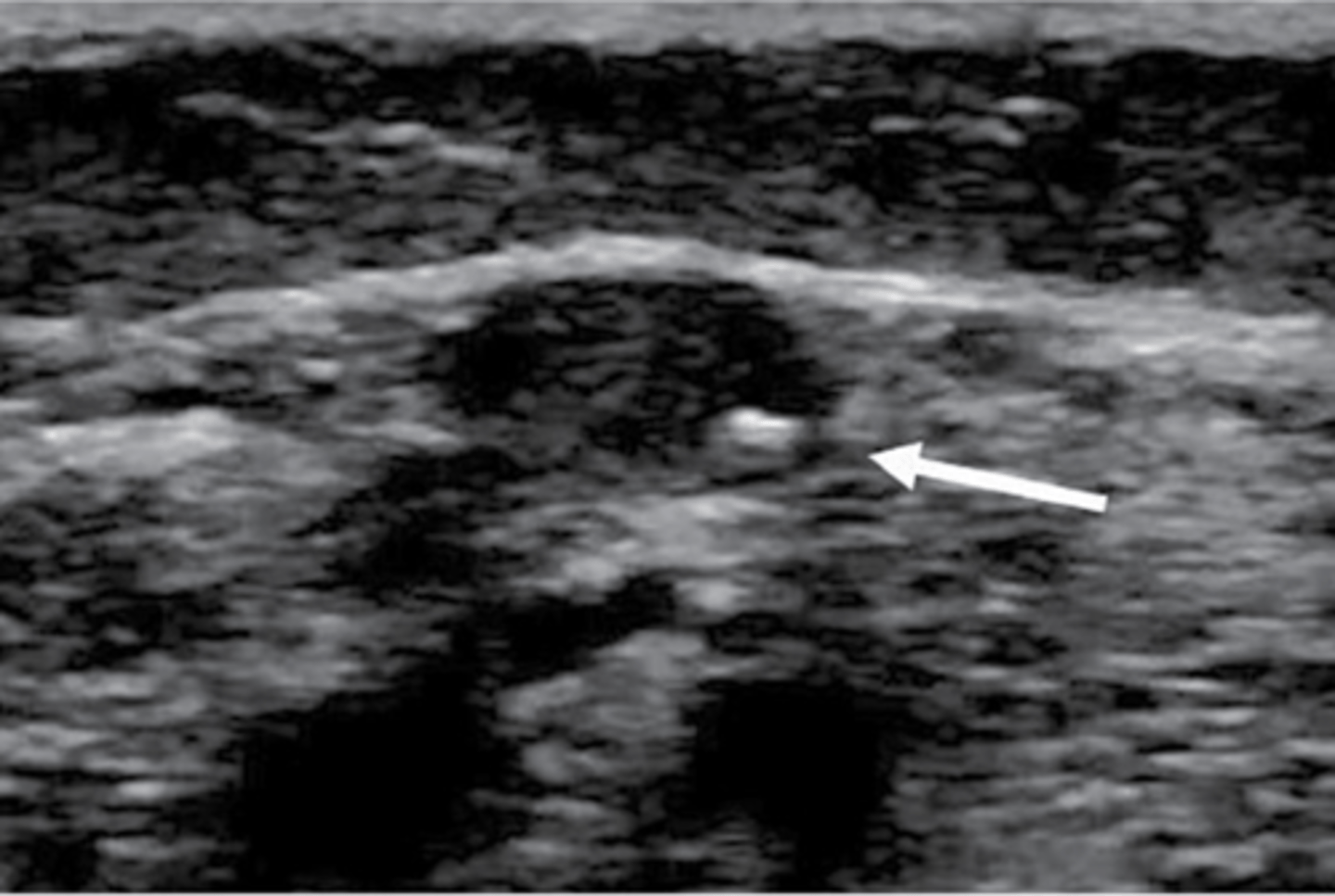 <p>Less common than arterial</p><p>Vein could still be usable</p>