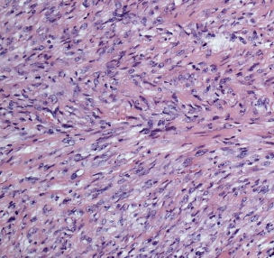 <p>1. differentiation score (0-3)</p><p>2. mitotic activity (0-3)</p><p>3. tumor necrosis (0-2)</p>