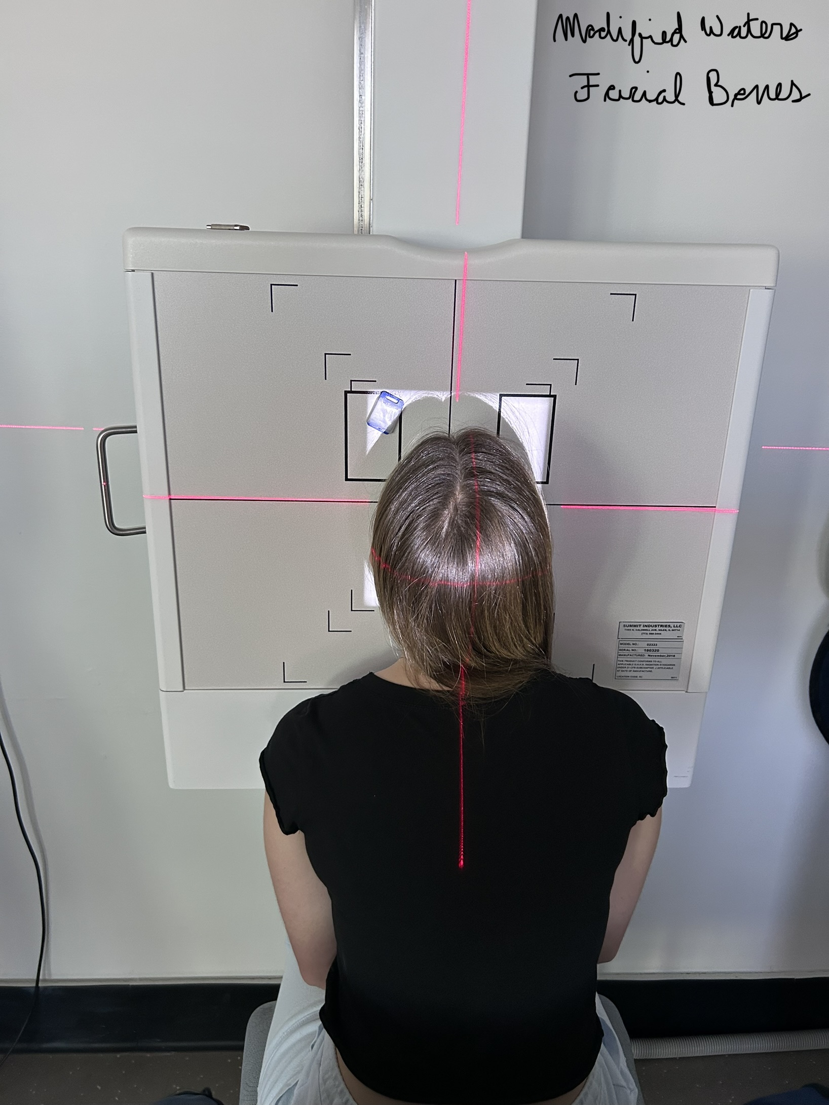Modified Parietoacanthial Facial Bones (Waters)