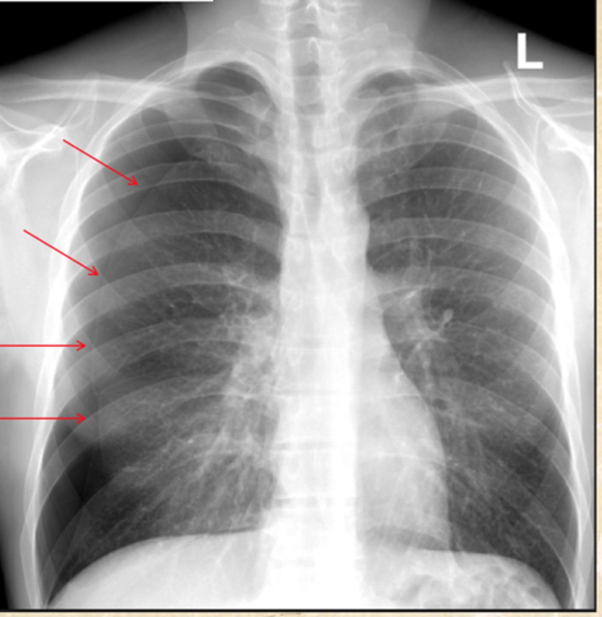 <p>What does this CXR show?</p>