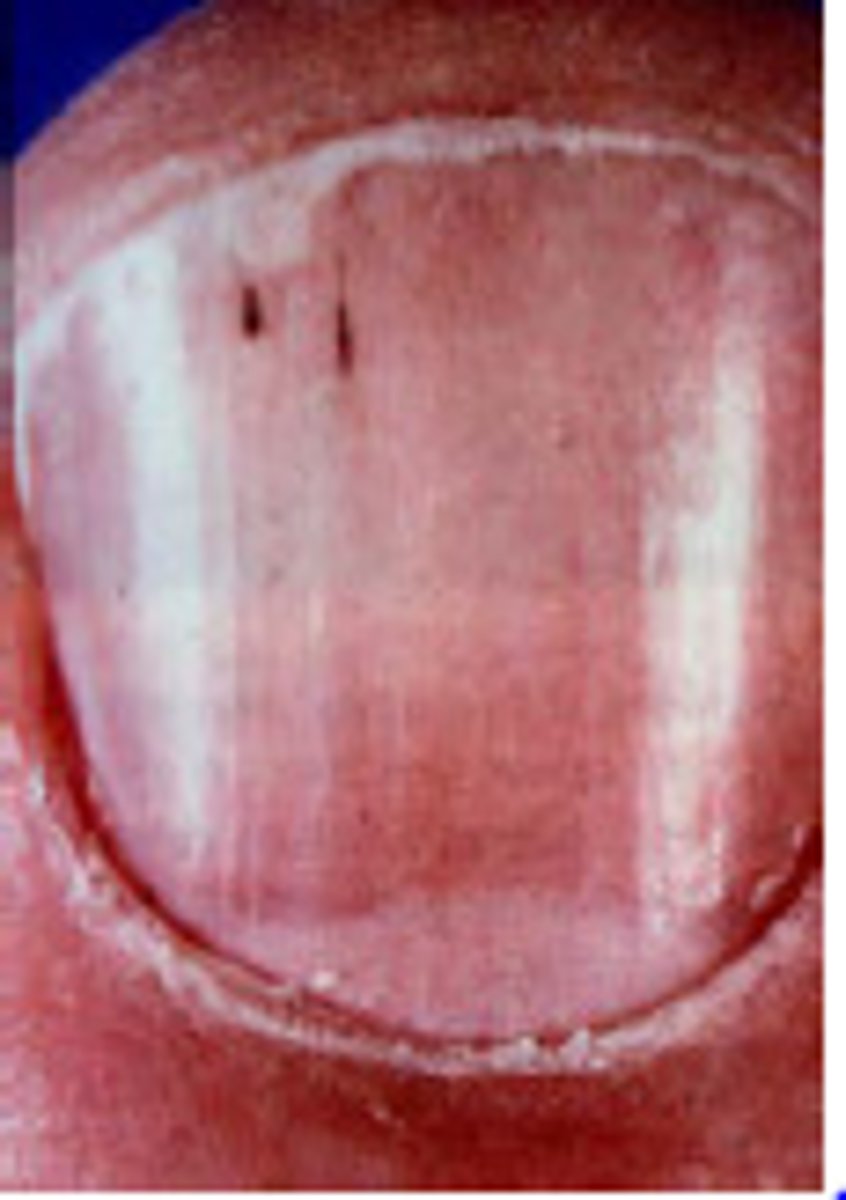 <p>Bacterial endocarditis</p>