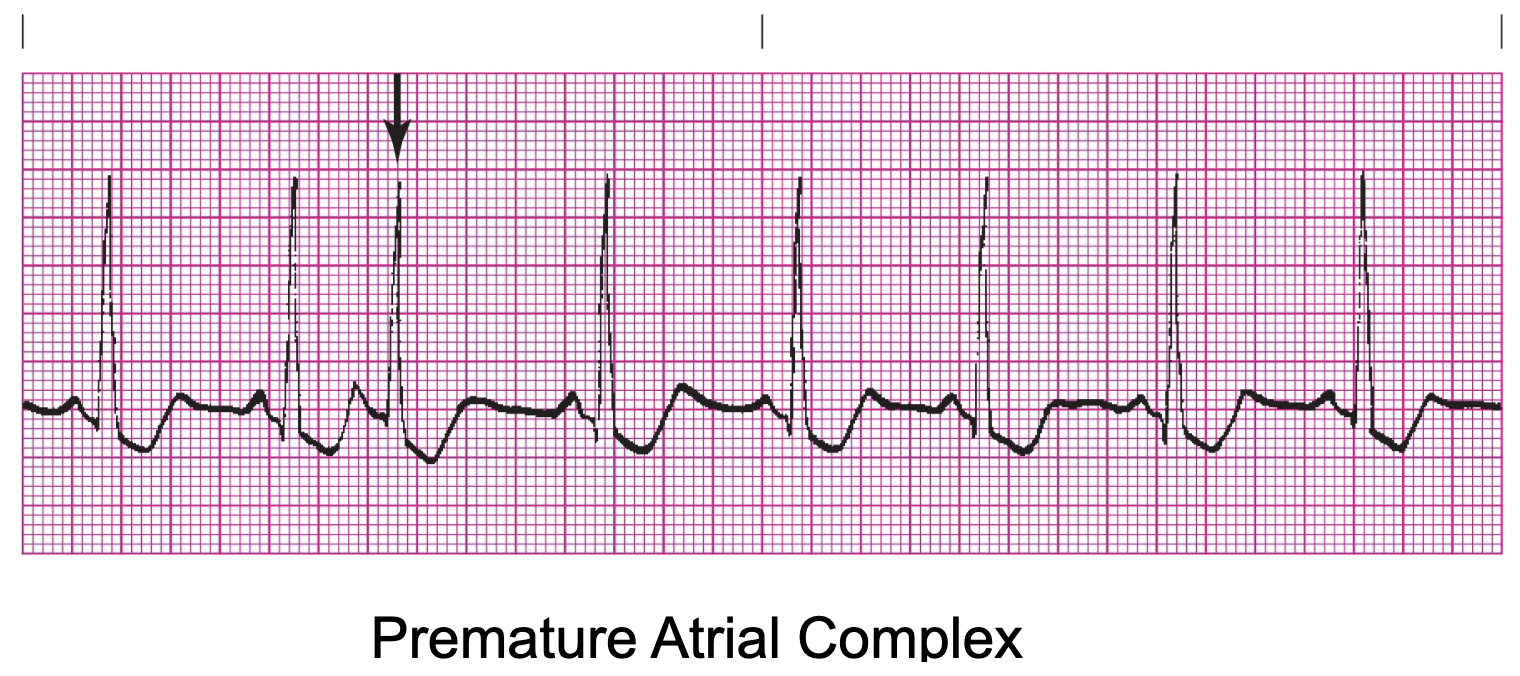 <p>The underlying rhythm is regular, but it is interrupted by ectopics</p>