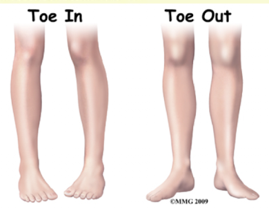 <ul><li><p><strong>Anteversion</strong> = abnormal or excessive <strong>forward rotation</strong> of a structure.<br>• Common example: <strong>Femoral anteversion</strong> → hip internally rotated → <strong>toes in</strong>, knees point inward.</p></li><li><p><strong>Retroversion</strong> = abnormal or excessive <strong>backward rotation</strong> of a structure.<br>• Common example: <strong>Femoral retroversion</strong> → hip externally rotated → <strong>toes out</strong>.</p></li></ul><p></p>
