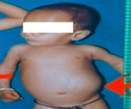 <p>Palpable abdominal mass</p><ul><li><p>Usually painless</p></li><li><p>Painful = advanced disease<br><br></p></li></ul><p>Found:</p><p>At home by parent</p><p>or pediatrician visit </p>