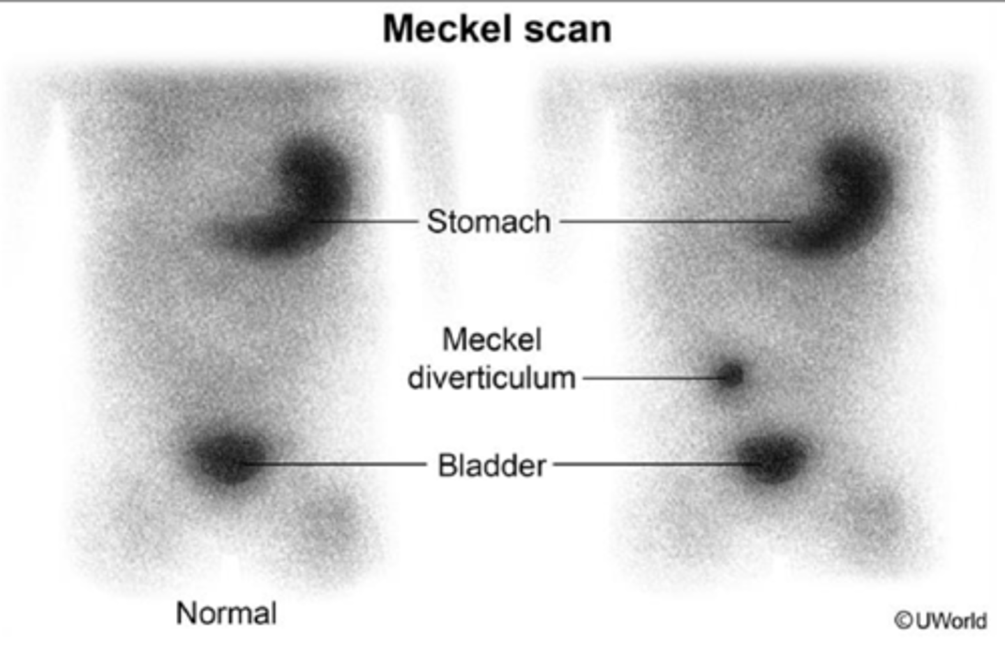<p>Define Condition:</p><p>Congenital outpouching of SI in ILEUM (w/n 2 feet of ileocecal valve)</p><p>-Hx:</p><p>&gt; MC Congenital Anomaly of GI tract</p><p>&gt; More common in Males</p><p>&gt; W/n first 2 years of life</p><p>-Path: Remnant of vitelline duct (omphalomesenteric duct - connects midgut to yolk sac)</p><p>&gt; DOESN'T Obliterate at Week 7 of Gestation</p><p>-Sx/PE:</p><p>&gt; MOST (95%) as Asx</p><p>If contains Ectopic gastric tissue (w/n 1st 2 years of life)</p><p>&gt; PAINLESS DARK RED GI BLEEDING (d/t injury of ileal mucosa from gastric acid)</p><p>&gt; "Lead Point" of intestines (if found, will see Sx of Intussusception)</p><p>-Dx: Meckel Radionuclide Scan</p><p>&gt; Radiotracer (99m Technetium pertechnetate) administered via IV</p><p>&gt; Tracer taken up by gastric mucosal cells --&gt; Gamma camera used to detect tracer ==&gt; Tracer detected in SI if it contains ectopic gastric tissue</p><p>-Tx:</p><p>&gt; Asx = None</p><p>&gt; Sx = Cut out (Diverticulotomy)</p>