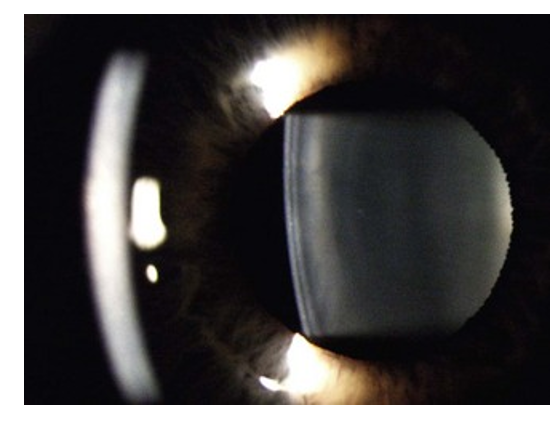 <p>Identify lens, iris, and crystalline lens</p>