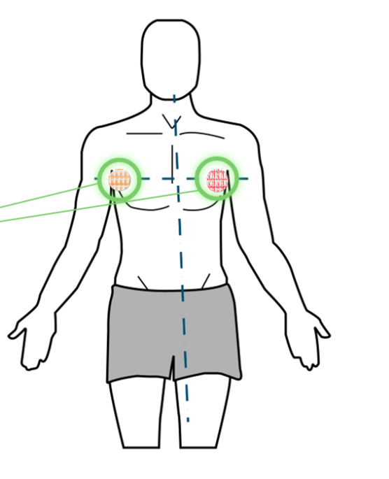 <p>Placed at 180 degrees from each other, in line with the lungs, on patient’s side.</p><p>Feed into the RespComp X algorithm</p>