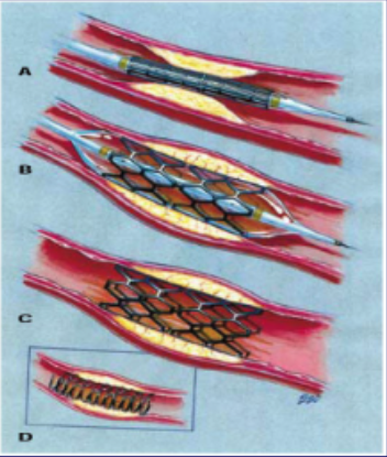<p>what are the types of stents used to treat myocardial infarctions?</p>