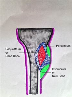 <ul><li><p>If osteomyelitis not managed or if treatment not sufficient → necrotic bone separates from healthy bone into dead segments → sequestra → chronic osteomyelitis</p></li><li><p>Abscess, or chronic infection may occur</p></li><li><p>Involucrum → prevents successful effects of antibiotics</p></li></ul>