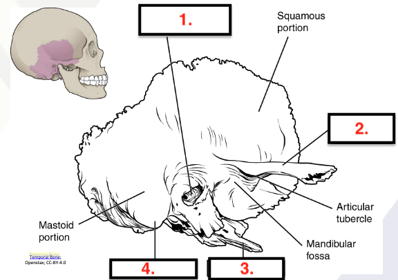 <p>Temporal bone</p>