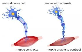 <p>What causes MS?</p>