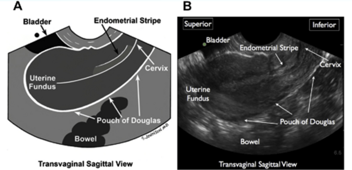 <p>Transvaginal Ultrasound for higher resolution and better visualization of uterus and ovaries</p>