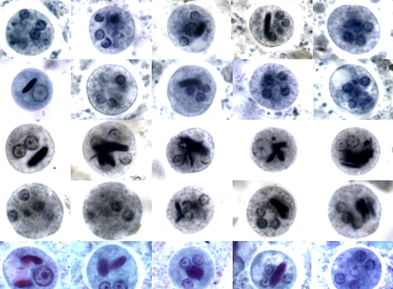 <p>Name: Entamoeba histolytica</p><p class="p1">Stage: cyst</p><p class="p1">*chromatoidal bar inside (cigar)</p><p class="p1">* 4 or fewer nuclei</p><p></p>