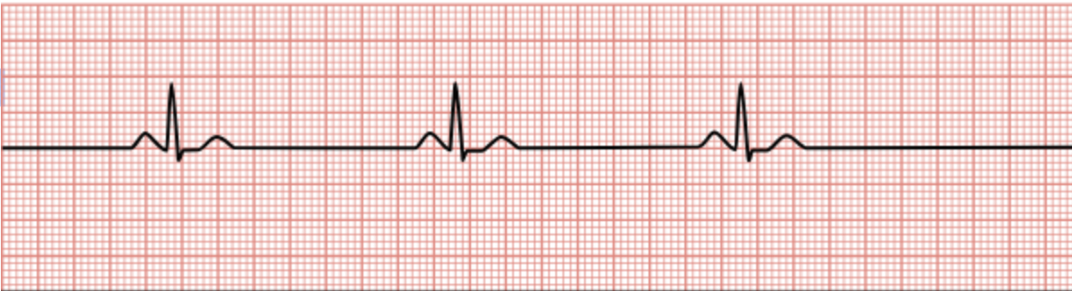 <p>Heart rate less than 60/min.</p>