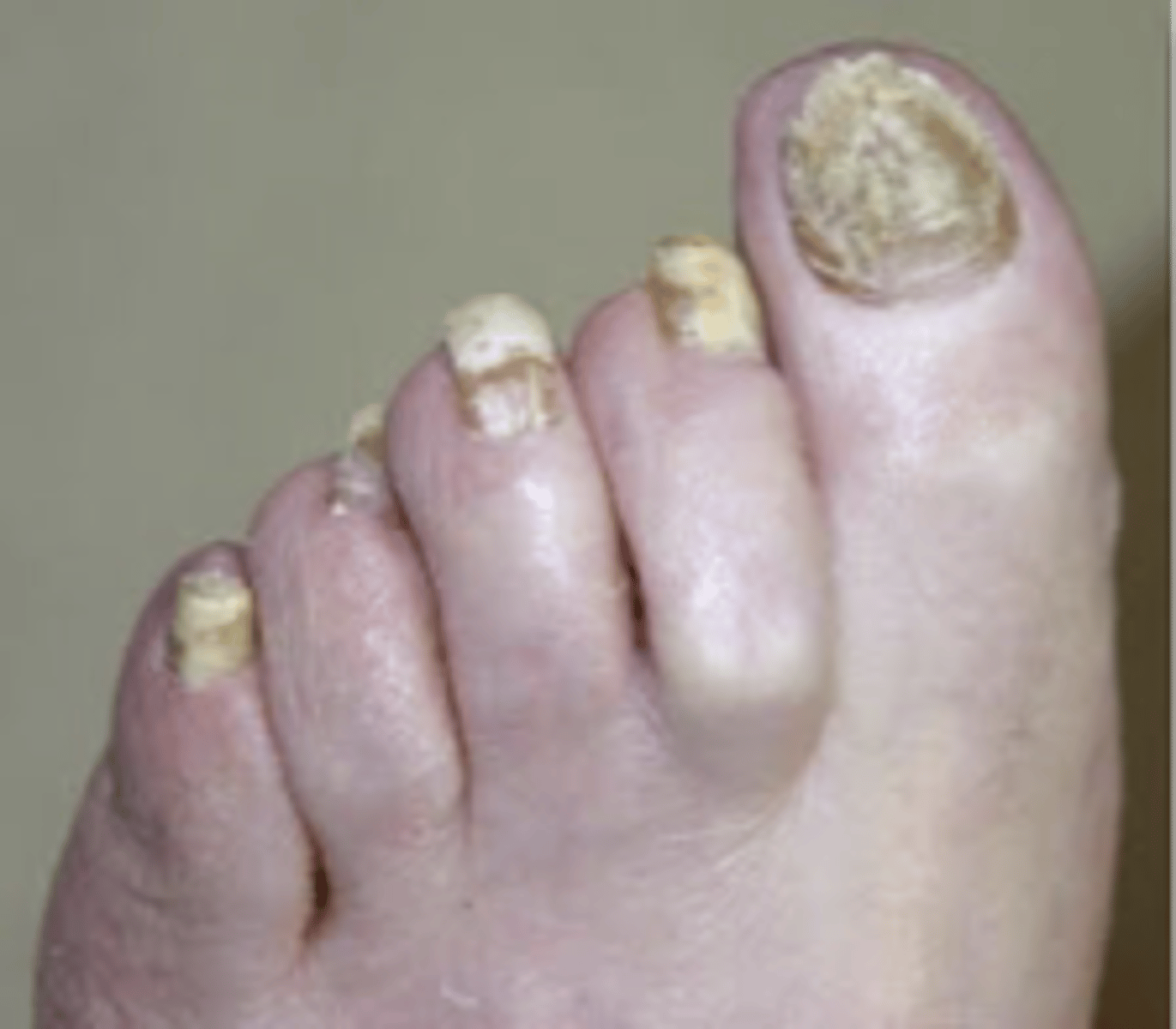 <p>name nail abnormality</p>