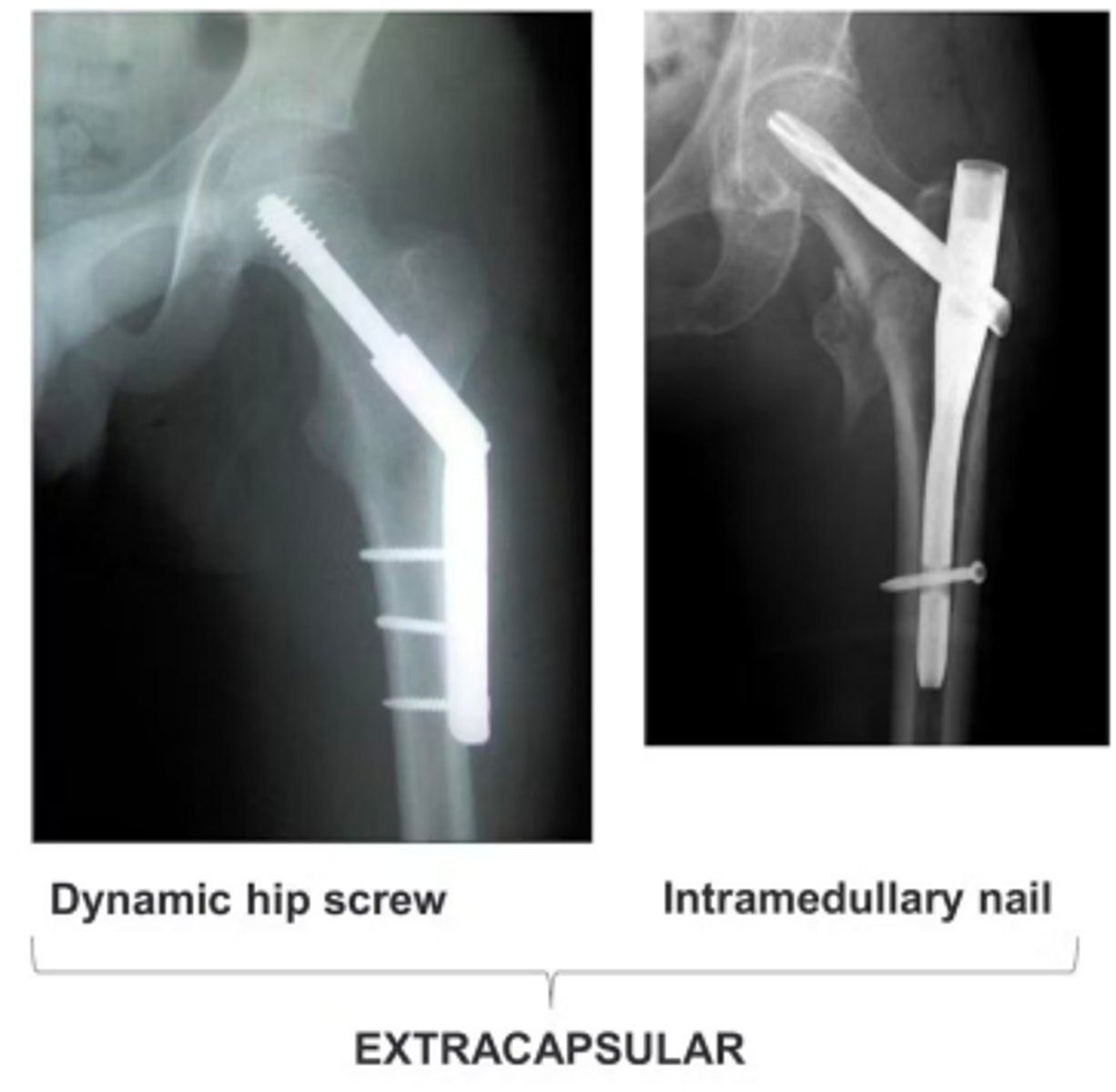 <p>Dynamic hip screw</p><p>Intramedullary nail</p>