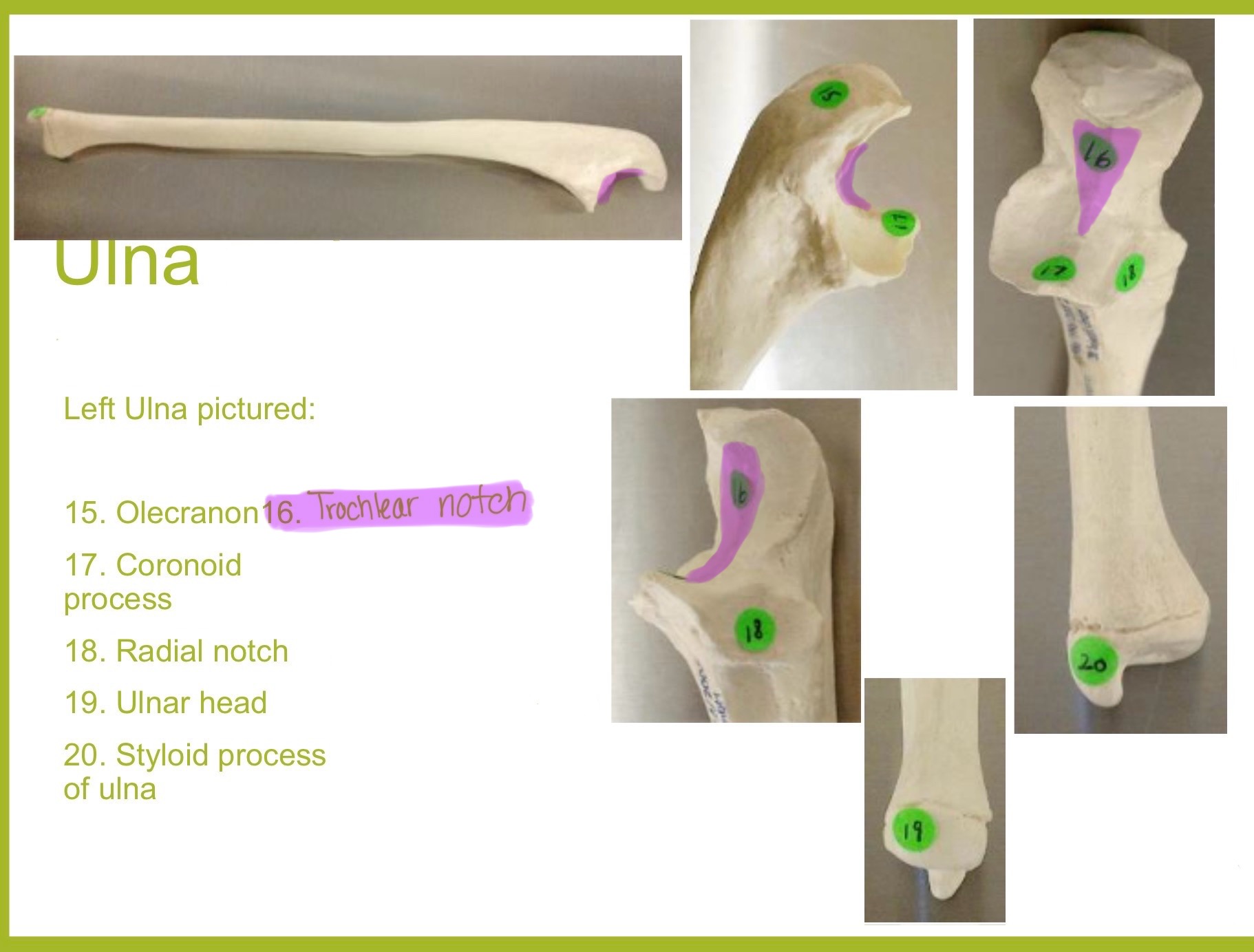 <p>trochlear notch of ulna</p>