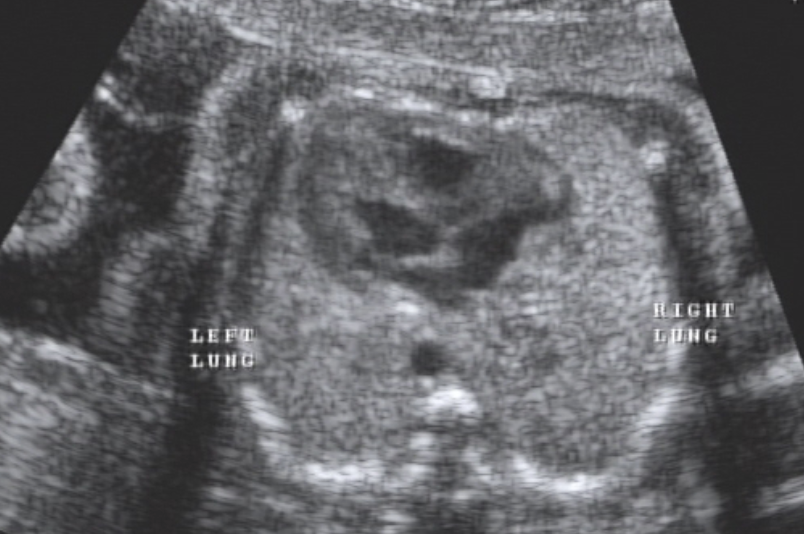 <ul><li><p>Symmetric &amp; homogenous</p></li><li><p><u>Early</u> in fetal life <strong>lungs</strong> echogenicity <span style="color: rgb(255, 0, 0);"><strong>≤</strong></span> to the <span style="color: rgb(0, 118, 255);">liver</span></p></li><li><p><u>Later</u> in pregnancy <strong>lungs</strong> echogenicity <span style="color: rgb(255, 0, 0);"><strong>≥ </strong></span>to the<span style="color: rgb(0, 118, 255);"> liver</span></p></li><li><p><strong>by volume</strong> : <span style="color: rgb(0, 118, 255);">right lung</span> is <u>slightly larger</u> than the <span style="color: rgb(0, 118, 255);">left</span></p></li><li><p>Ultrasound <u>cannot determine</u> <span style="color: rgb(226, 0, 0);">lung maturity</span></p></li><li><p><strong>Fetal breathing</strong> <u>does not indicate</u> lung maturity</p></li></ul><p></p>