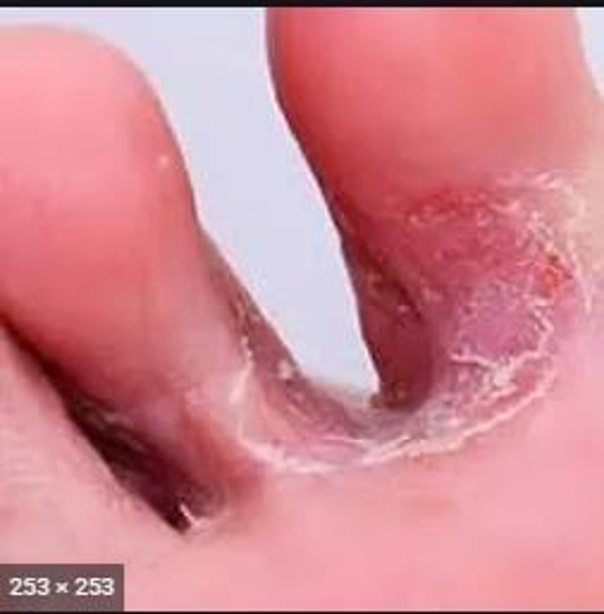 <p>A fungal infection commonly known as athlete's foot.</p>