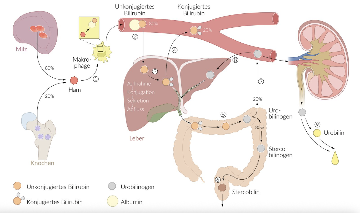 <p>A. Bilirubin in the damaged liver is not sufficiently converted into a more water-soluble form</p>