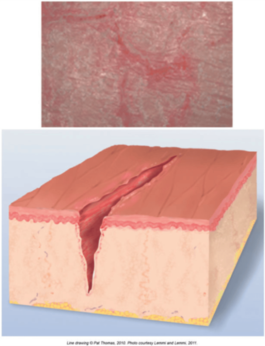 <p>A linear crack in the skin often resulting from excessive dryness</p>