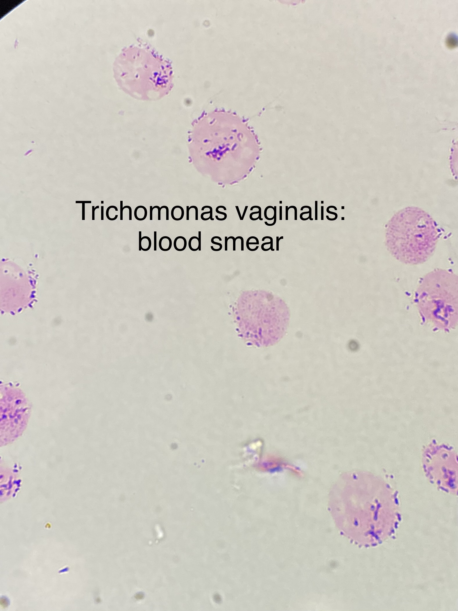 <ul><li><p>causes trichomonas </p></li><li><p>a STD </p></li><li><p>20% Asymptomatic </p></li><li><p>women affected more than men </p></li><li><p>risky for pregnant women </p></li></ul>