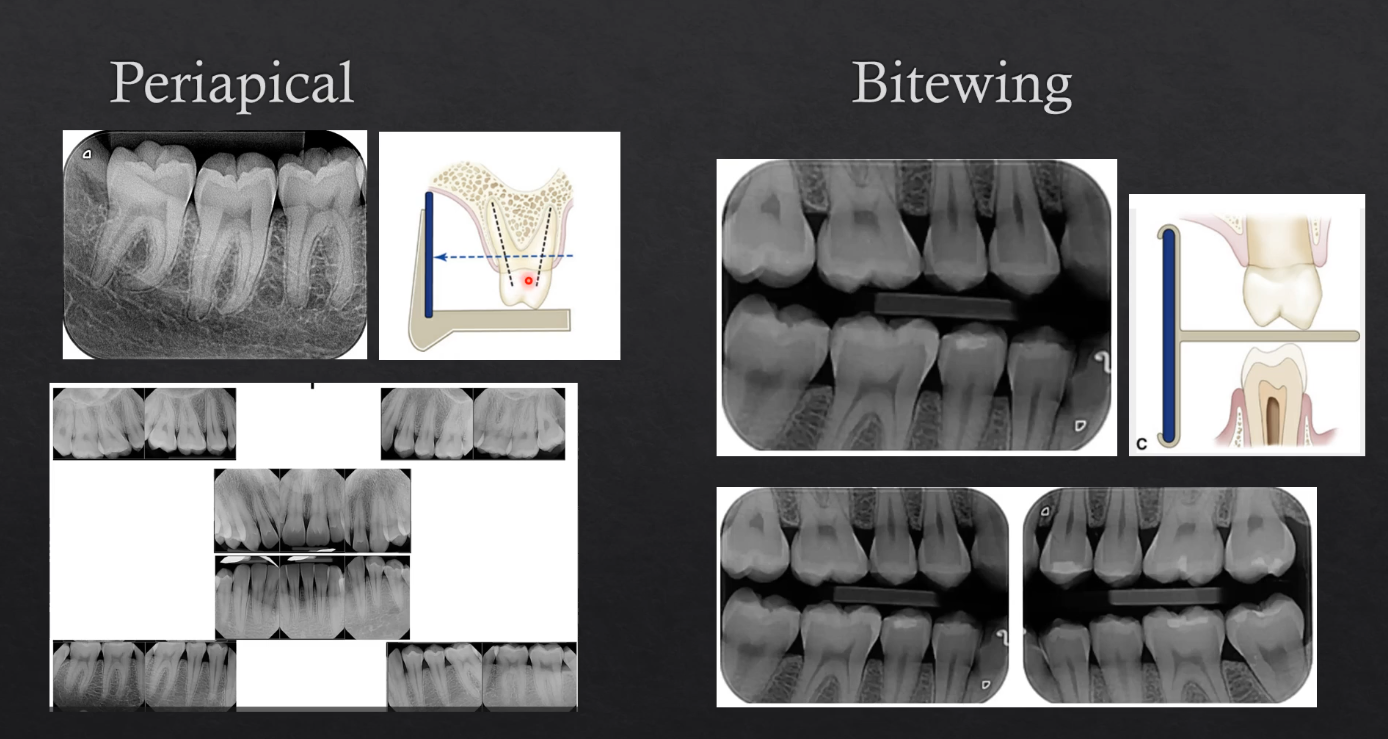 <p>periapical is when the film is positioned such that the entire tooth is imaged - the crown to the apex of the roots and ideally3 or 4 mm of bone below the apex of the tooth - can be of a single part of the jaw or multiple in different images - takes an image of 3 or 4 teeth at a time </p><p>bitewings are also intraoral but the patient bites on a little peg the goes between the teeth → detector is imaging the<strong> bottom and the top teeth</strong> - all we see is the<strong> crown and the bone levels </strong></p>