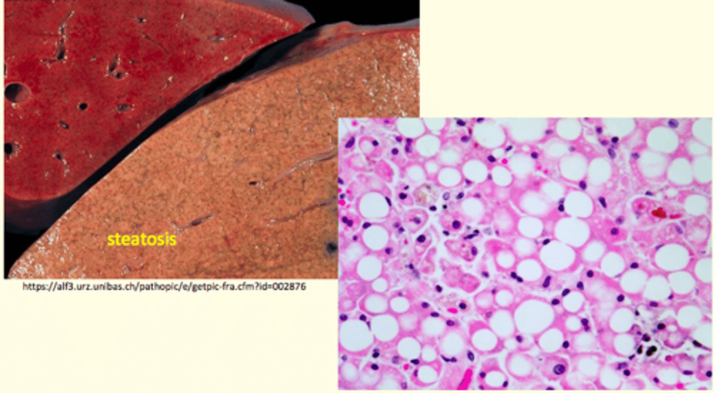 <p>Abnormal condition of fat accumulation (increased fat at the cellular level often affecting the liver)</p>
