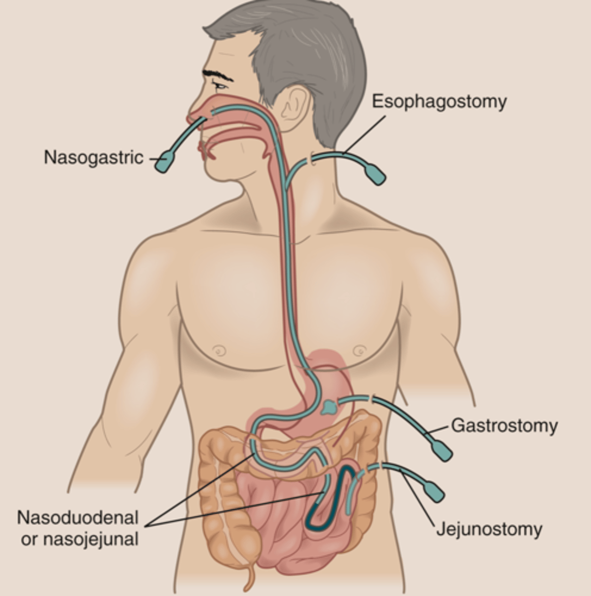 <p>NG tube → start in nose and end in stomach</p><p>NJ tube → start in nose and end in jejunum</p><p>ND tube → starts in nose and ends in duodenum</p><p>Orogastric tube (OG) → starts in mouth and ends in stomach</p><p>Gastrostomy tubes (g tube) → placed thru skin straight into stomach</p><p>Jejunostomy tube (j tube) → placed thru skin straight into small intestine</p>