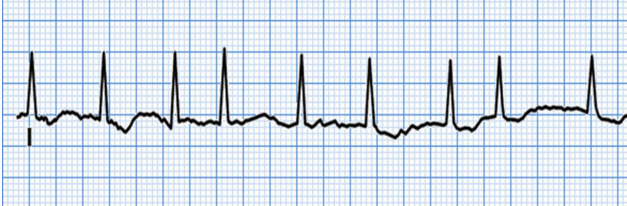 <p>What does this EKG show?</p>