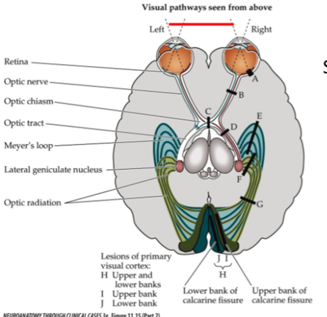 <p>Right optic tract</p>