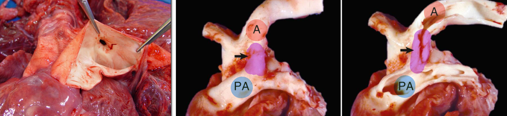 <ul><li><p>The ductus arteriosus is a <u>connection</u> between the <u>pulmonary artery and the aorta</u> in the fetus</p></li><li><p>When it doesn’t close after birth, it becomes a PDA</p></li></ul><p></p>