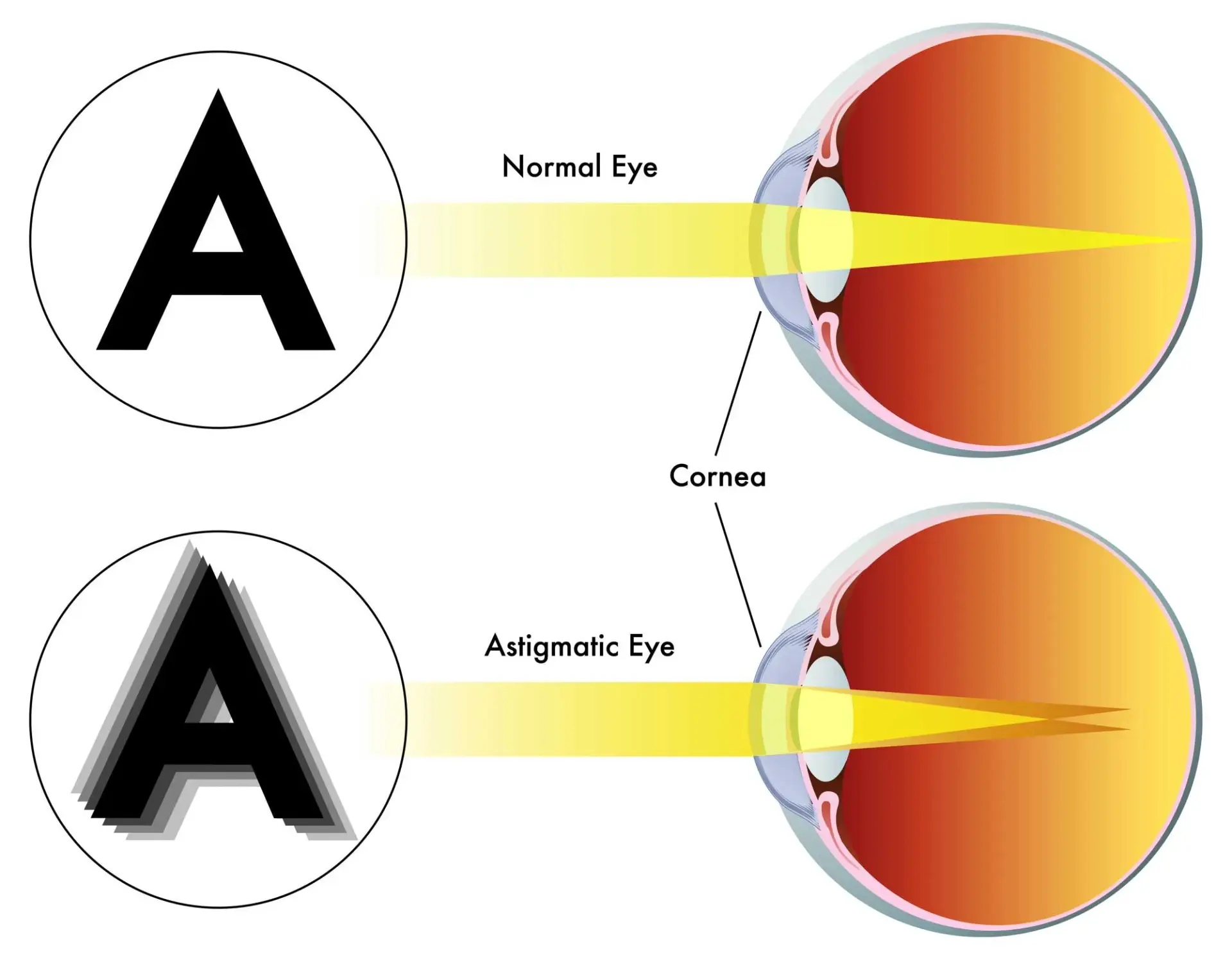 <p>a common eye condition where the cornea, the clear front part of the eye is not perfectly curved; results in uneven light focus on the retina, resulting in blurred or distorted vision.</p>