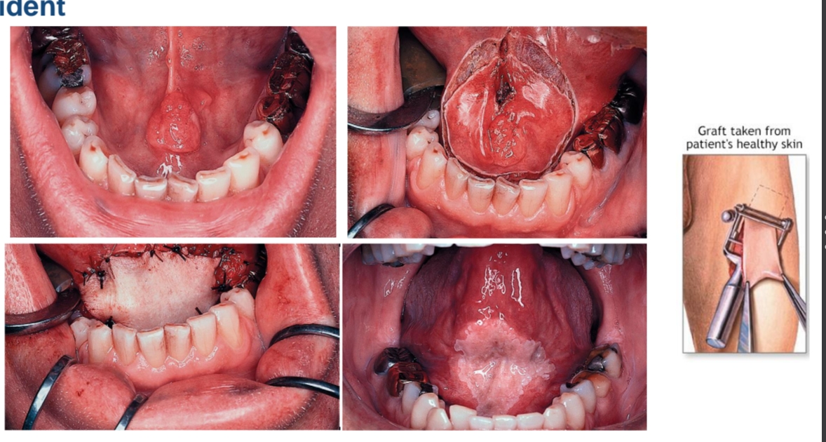 <p>wondcontractie → de flap gaat krimpen door litteken vorming</p>
